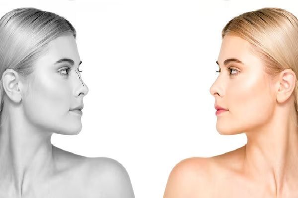 Non-Surgical Rhinoplasty