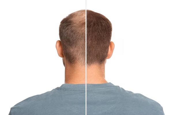 man with hair loss problem before and after treatment