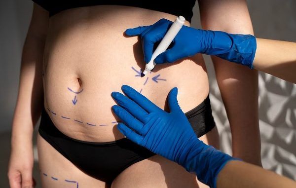 abdominoplasty clinics in Mexico City