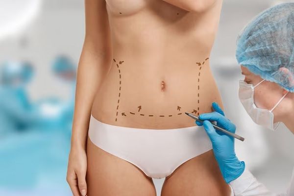 woman marked out for cosmetic surgery. abdominoplasty