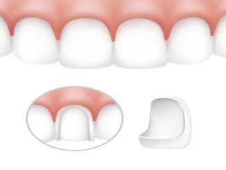 Dental Veneers Clinics