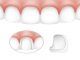 Dental Veneers Clinics