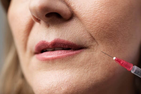 Close up smiling woman hyaluronic acid injection 